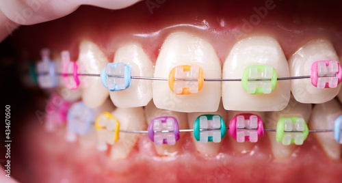 Macro snapshot of teeth and ceramic braces with colorful rubber bands on them. Concept of dentistry and orthodontic treatment. photo