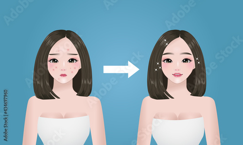 Acne problem. Pretty woman's face before and after concept. 