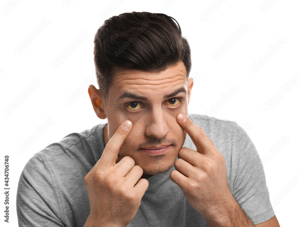 Man checking his health condition on white background. Yellow eyes as symptom of problems with liver Man checking his health condition on white background. Yellow eyes as symptom of problems with liver