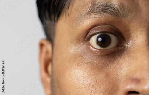 Foto yellow eye - symptom for health problem