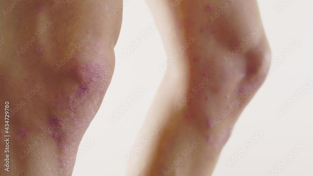 homme, psoriasis, eczéma, problème de peau, médicale, corps, femme, nu, sein, beauté, jeune, beau, peau, torse, poitrine, santé, blanc, modèle, fitness, musculaire, mince, isolé, sain, arrière, main, 