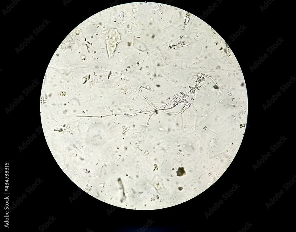 Yeast Infection; Budding yeast and pseudohyphae of Candida albicans