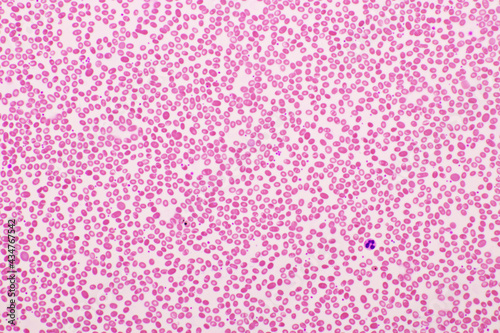 Red blood cells in blood smear  Wright-Giemsa stain  analyze by microscope  400x