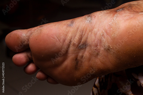 Closeup of the foots sole of a woman suffering from chronic psoriasis on a black background. Closeup of rash and scaling on the patient's skin. Dermatological problems. Dry skin Isolated © sameer