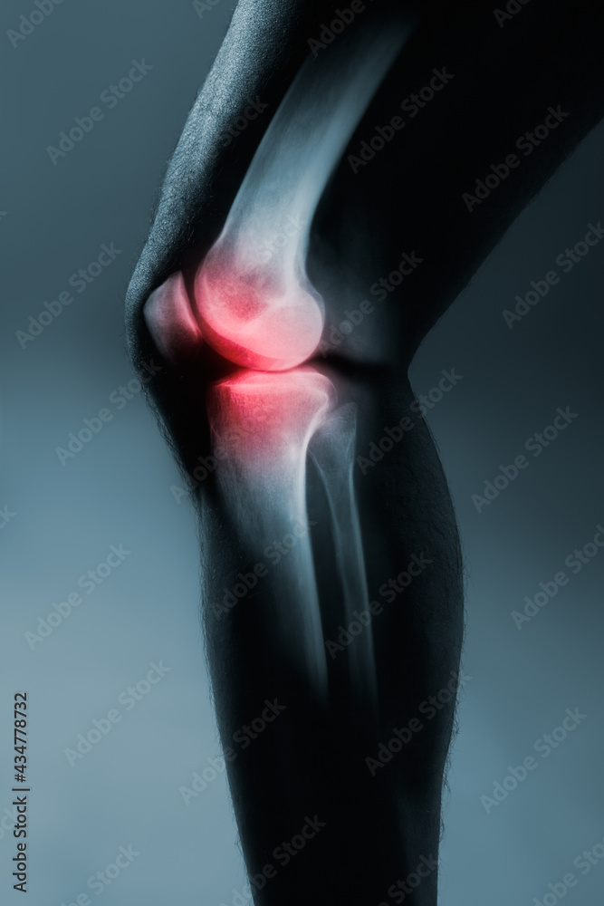 Fototapeta premium Human knee joint and leg in x-ray, on gray background