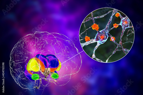 Dorsal striatum and its neurons in the Huntington's disease, 3D illustration photo