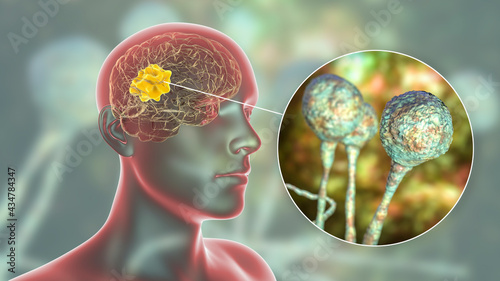 Brain mucormycosis, a brain lesion caused by fungi Mucor photo