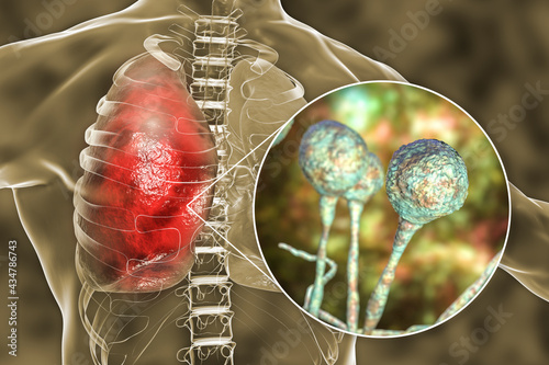 Lung mucormycosis, a lung disease caused by fungi Mucor, also known as black fungus photo