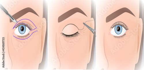 blepharoplasty procedure, plastic surgery of the upper eyelid