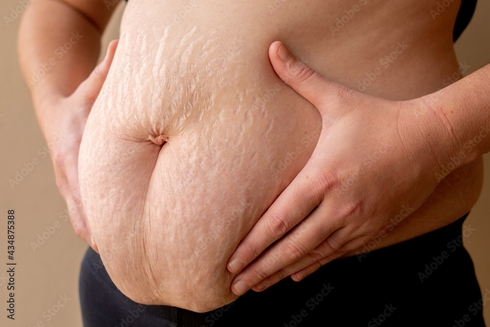 woman holding her fat belly with stretch marks woman holding her fat belly with stretch marks