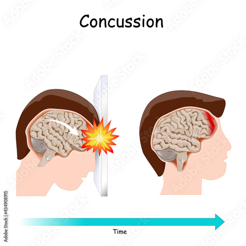 Concussion. brain  after head trauma.