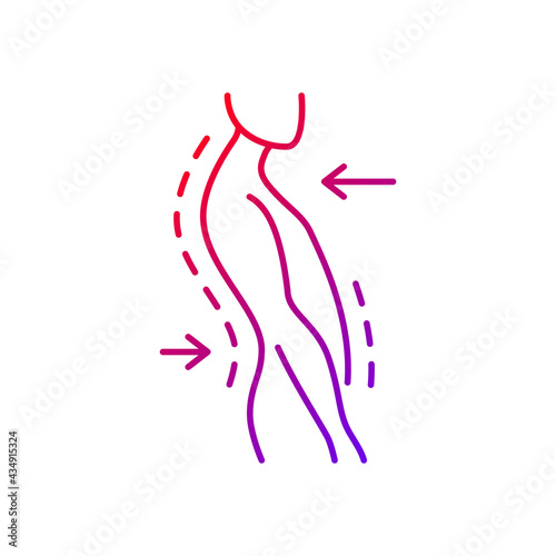 Swayback posture gradient linear vector icon. Spine curvature disorder. Poor posture. Postural deformity. Thin line color symbols. Modern style pictogram. Vector isolated outline drawing
