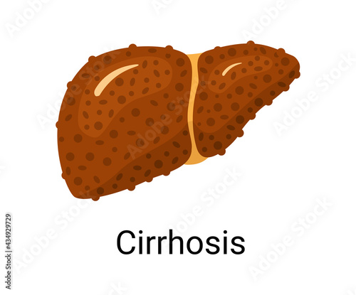 Liver cirrhosis  isolated on white background. Liver disease concept illustration in flat design.
