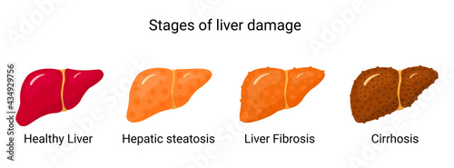 Stages of liver damage. Vector illustration liver conditions in flat style