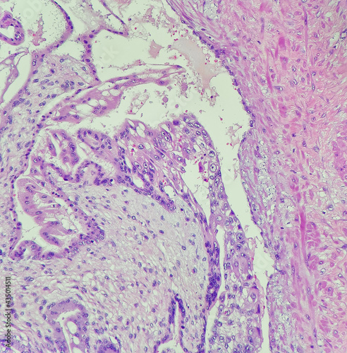 Photo of invasive hydatidiform mole, showing vascular invasion of abnormal chorionic villi, high magnification (200x), photo under microscope photo