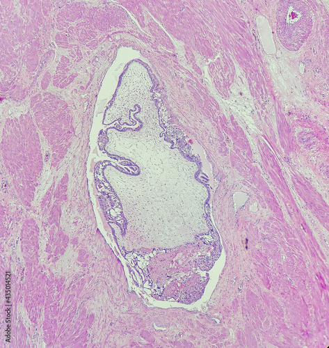 Photo of invasive hydatidiform mole, showing vascular invasion of abnormal chorionic villi, magnification 40x, photo under microscope photo