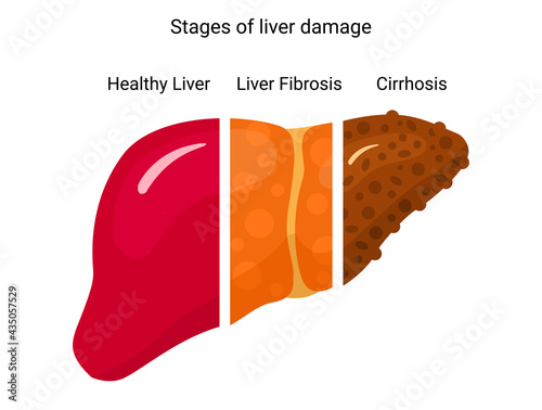 Stage of liver damage. Design for poster, infographic, presentation. Liver disease.