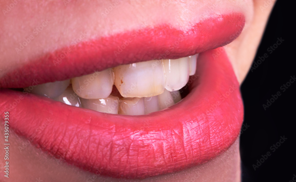 Obraz premium Close Up Dirty crooked yellow Teeth young lady smiling, Sensual female plump Lips woman smile. Dental restoration surgery concept . Health dentist concept