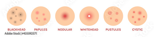 Set of isolated icons types of acne. Pimples and skin close up. Round colored flat realistic style. Problem skin. White background. Vector stock illustration.