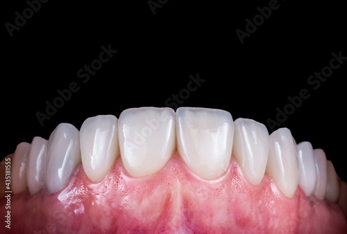 teeth treatments with crowns and venners