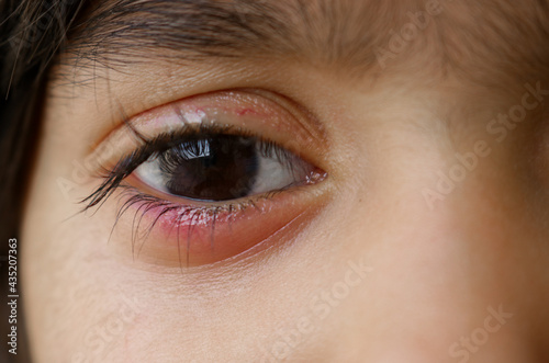 Swelled right eye of a little girl, Swelling eye of a child, Infection on eye. Allergic redness on eye. photo