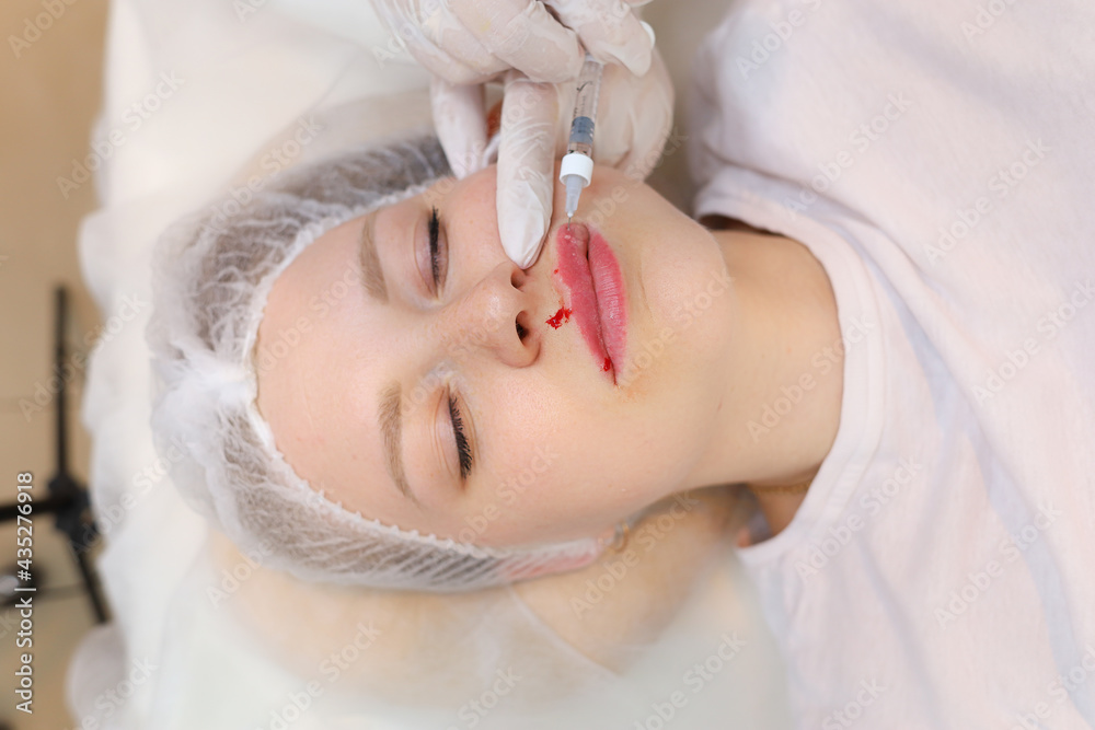 The beautician inserted a needle from the syringe all the way to its base to evenly distribute the hyaluronic acid in the client's lips The beautician inserted a needle from the syringe all the way to its base to evenly distribute the hyaluronic acid in the client's lips