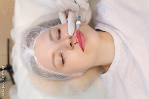 The beautician inserted a needle from the syringe all the way to its base to evenly distribute the hyaluronic acid in the client's lips