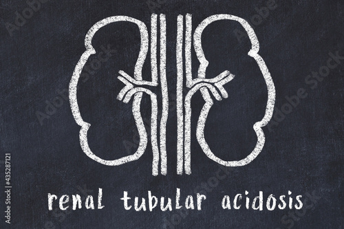 Chalk drawing of human kidneys and medical term renal tubular acidosis. Concept of learning medicine photo