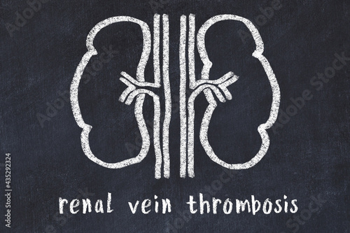 Fotografi Chalk drawing of human kidneys and medical term renal vein thrombosis