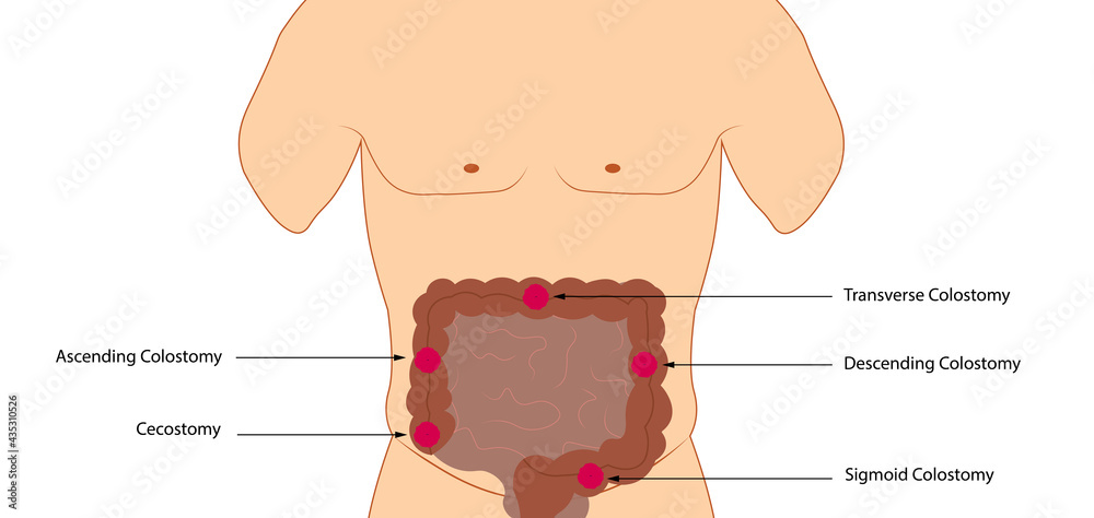 Colostomy anatomy positioning of stoma - Illustration of anatomy ...