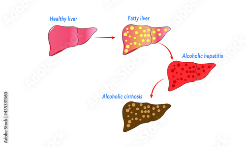 Alcoholic liver disease [Fatty liver, hepatitis, cirrhosis]