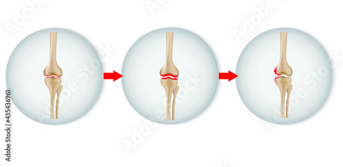 Illustration of Arthritis knee joint icon. Rheumatoid arthritis icon. Pain in leg. Human bone anatomy flat vector illustration. Painful injury erosion.