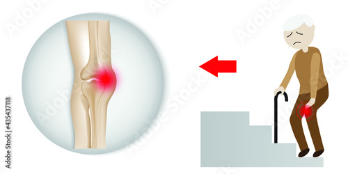 Illustration of Arthritis knee joint . Rheumatoid arthritis. Pain in leg in elderly man. Elderly man in knee joint pain white icon khee joint injury on a white background.