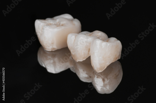 Dental bridge of 3 molar teeth. Prosthetic dentistry. Tooth recovery with implant. Close-up photo of metal free ceramic teeth crown isolated on black glass background