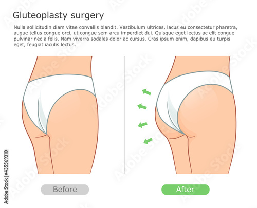 Gluteoplasty surgery illustration before and after. Buttocks correction procedure with implantation.