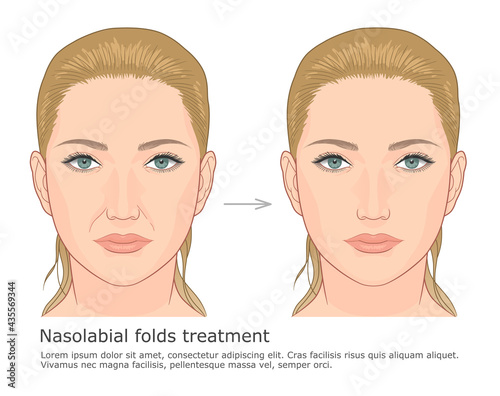 Nasolabial folds correction medical illustration. Treating deep nasolabial folds with facial filler.