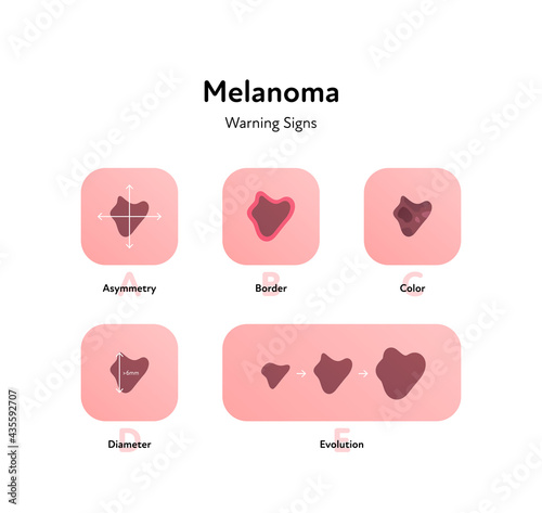 Melanoma cancer anatomical infographic poster. Vector flat medical illustration. Warning signs of tumor disease. Asymmetry, border, color, diameter. Design for healthcare, oncology, dermatology.