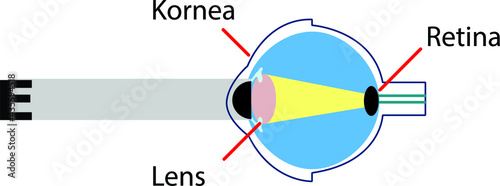 Vector Illustration of an Eye Anatomy Astigmatic
