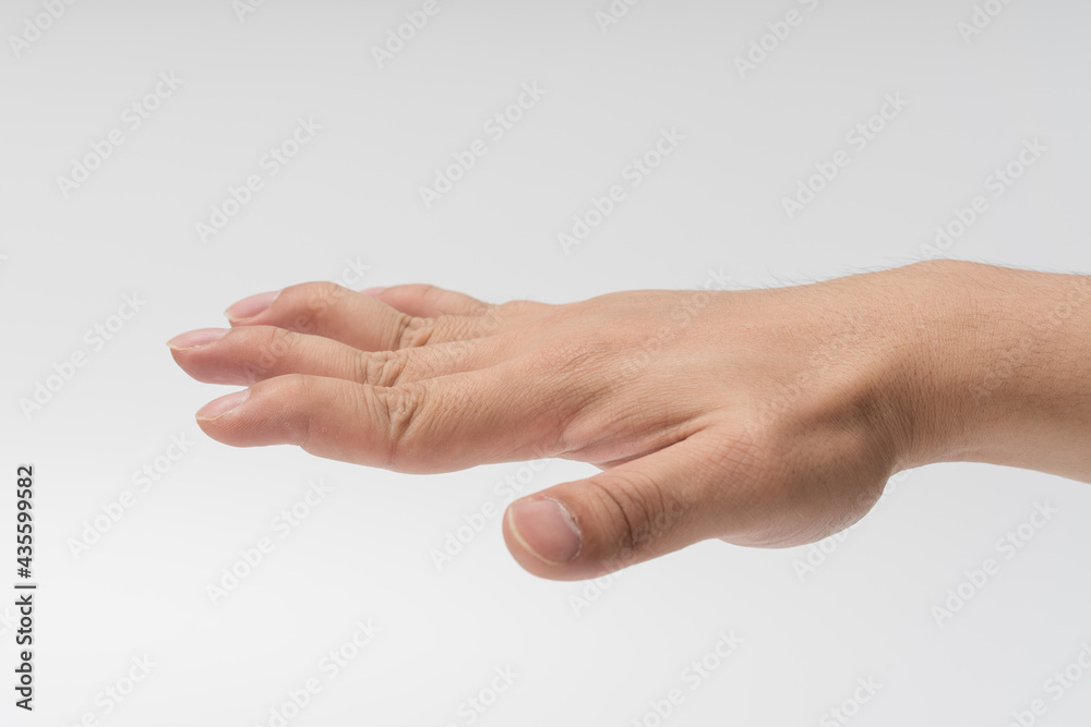 Malformed palms of men on a white background Malformed palms of men on a white background