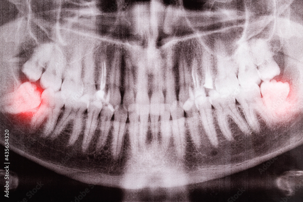 Impacted Wisdom Tooth Xray