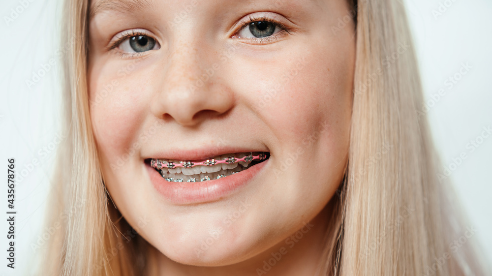 Smiling blonde girl with orthodontic braces close-up, orthodontic treatment Smiling blonde girl with orthodontic braces close-up, orthodontic treatment