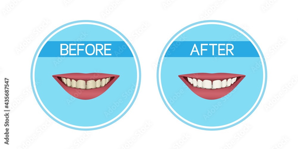 Fototapeta premium Teeth whitening: before and after. Yellow teeth and white teeth. Realistic vector illustration.