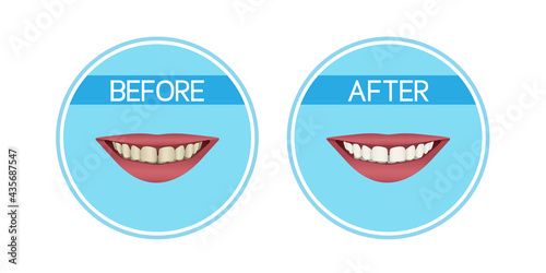 Teeth whitening: before and after. Yellow teeth and white teeth. Realistic vector illustration.