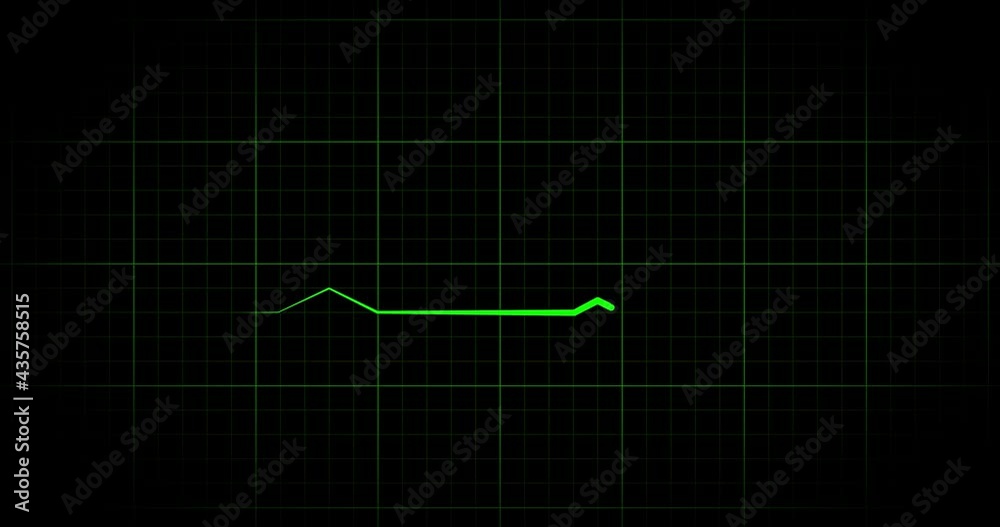 4K Heartbeat cardiogram on green grid. Normal sinus rhythm and lack of heartbeat. Life and death 4K Heartbeat cardiogram on green grid. Normal sinus rhythm and lack of heartbeat. Life and death