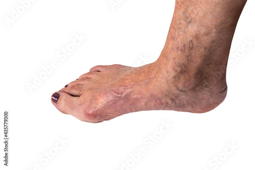 Hallux valgus, bunion on elderly woman's foot isolated on white background. Painful toe joint deformity with toe misalignment. Concept of medical health care. Closeup, side view.