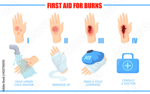 Ways of healing different skin burn injuries. Cartoon vector illustration. First aid methods for different degrees of skin burns. Treatment, first aid, fire concept for banner design or landing page