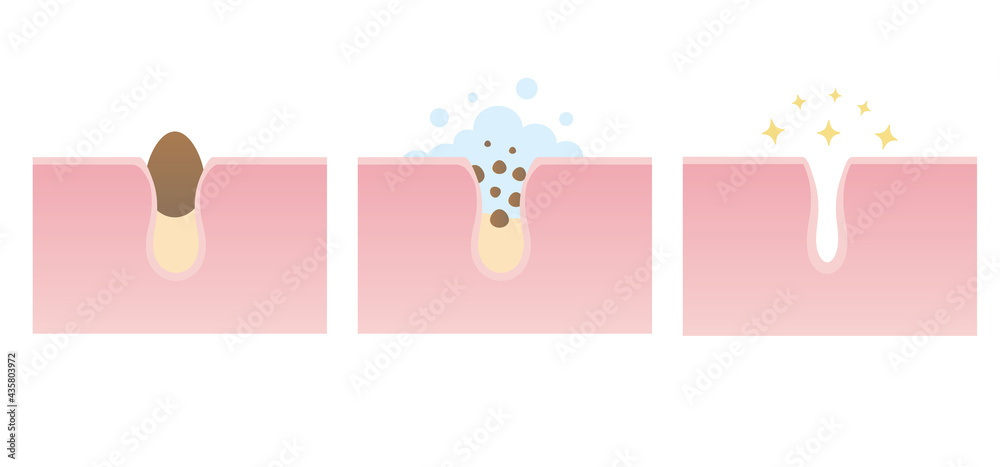 Vector illustration of skin care. Steps of pore cleaning.Blackheads removal, skin cleaning foam, skincare. Can be used for topics like cosmetology, cosmetics. Concept of skin treatment Vector illustration of skin care. Steps of pore cleaning.Blackheads removal, skin cleaning foam, skincare. Can be used for topics like cosmetology, cosmetics. Concept of skin treatment