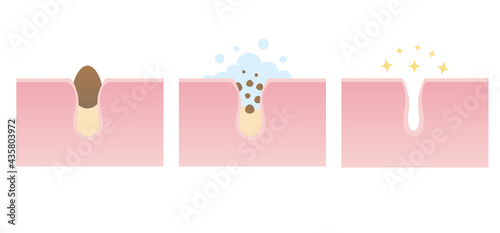 Vector illustration of skin care. Steps of pore cleaning.Blackheads removal, skin cleaning foam, skincare. Can be used for topics like cosmetology, cosmetics. Concept of skin treatment