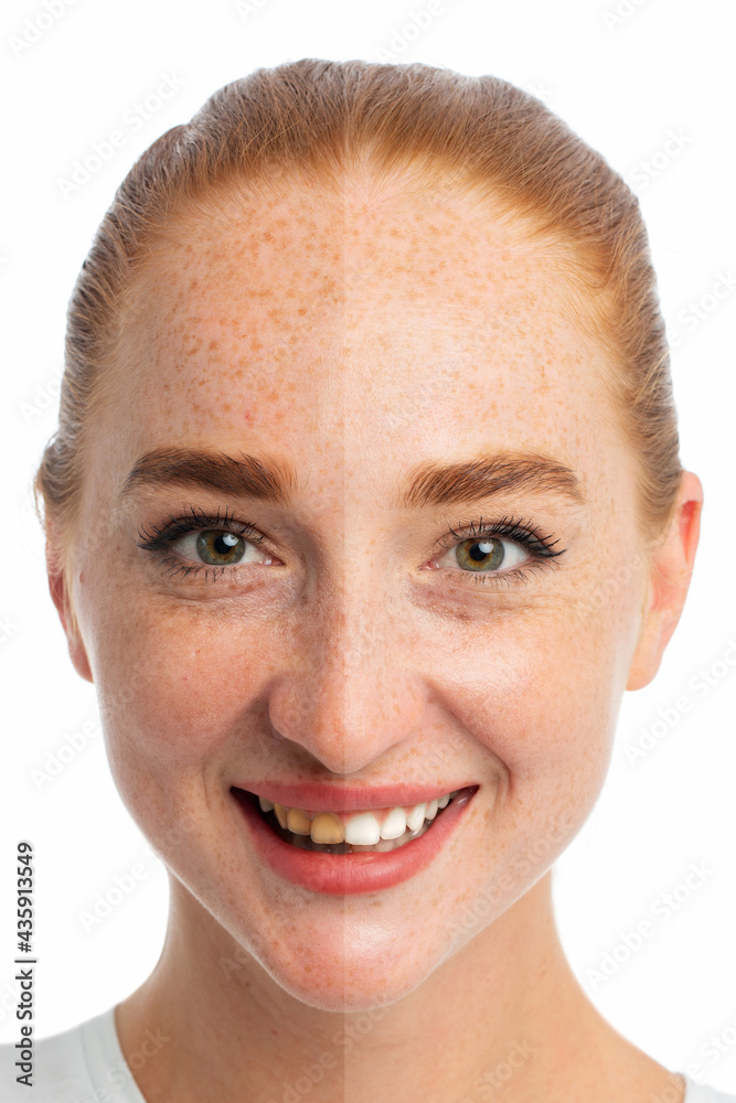 Obraz premium Before after concept, model with bad tooth before and white tooth after