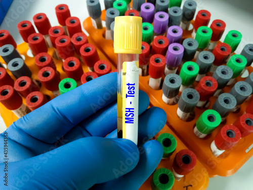 Blood sample tube for Melanocyte-Stimulating hormone (MSH) test with laboratory background.MSH is essential for preserving the skin from ultraviolet rays, development pigmentation,controlling appetite photo
